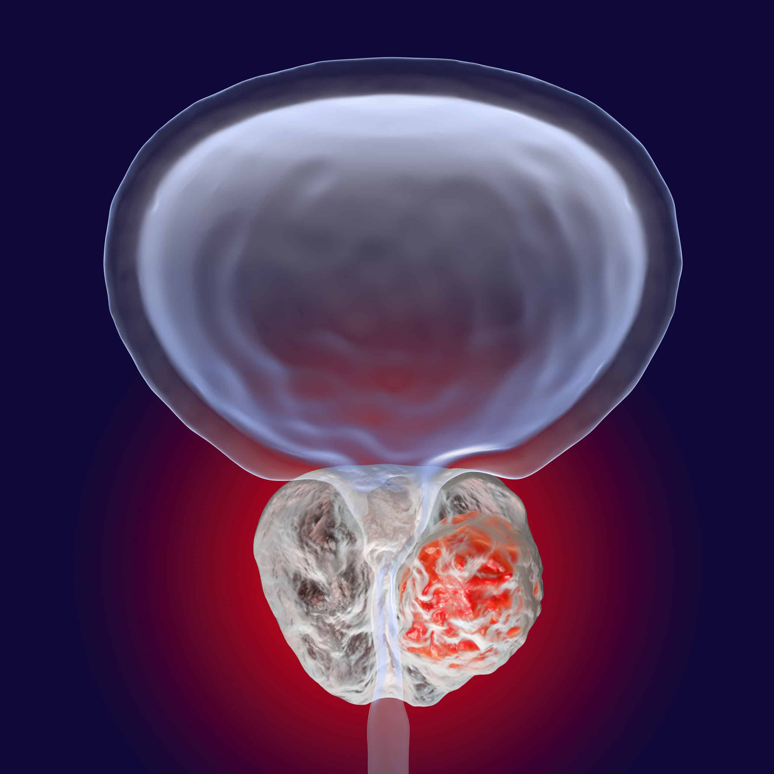 Prostate cancer, 3D illustration showing presence of tumor inside prostate gland which compresses urethra